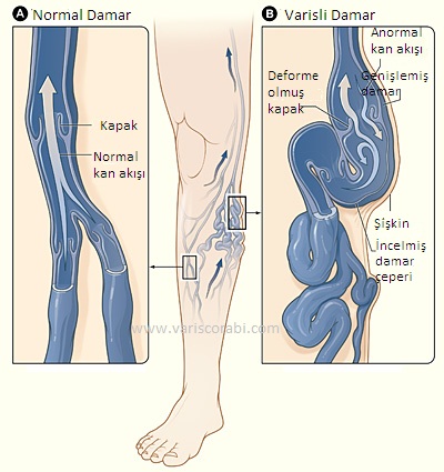 Normal ve Varisli Damar