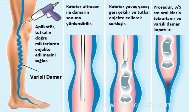 Venaseal Prosedürü